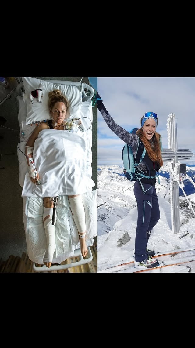 Story of my life…✨💫It’s 10 years ago today… I was on the top of my (former) life… modeling, racing in Trailrunning and Skimountaineering. A photoshooting on a mountain in Island changed everything… I felt down 800 Highmeters over ice rocks and snow and broke nearly every bone in my body. I faced death on that 3rd of April 2014. It’s exactly 10 years ago, that this horrible accident happened…that day, I thought I had to die and it felt, like I had lost everything that was important to me: my health, my physical and mental intactness.I didn’t die. I had a fantastic crowd of family and friends behind me, who supported me so incredibly good. Thanks to every single one 🙏🏻🫶🏻. I fought back with all of my heart, all of my power. I was awarded with the „Bayerischer Sportpreis“ in 2016 for my mental strength on my way back to the summit. I started speaking infront of a big audience and I wrote two books, to empower others to believe in their own inner strength. I became an ambassador for blood donations, which saved my life. And I went back to Island, to heal my soul…But the very best: I met @andiwittmannofficial! A super smart guy, MTB-Slopestyler, far away from my state of health at that time. Call it fortune… He also had a bad MTB-crash just a couple of months after we‘ve met the first time. It came up, that we trained and sweated in rehab together and we felt in love. Today we are married and have two wonderful kids together 💕. So today, 10 years after, I can summarize: My life wasn’t over that day in April 2014… it was horrible at the beginning and everything than easy over years, but my life and my soul was supposed to rise and to unfold its full potential for me 🫶🏻💫.If you‘ll have a big challenge the next time: believe in yourself, believe, that everything will fall into place one day if you open your heart ❤️.Thanks so much to everyone who supported me the last 10 years 🫶🏻💫💕. #withheartwideopen #realstory #storyofmylife #accident #gelaallmann #10years #friends #accident #10yearschallenge #bergzeit #familie #positivity #fightsmilelove #mindset #mentalstrength #rehab #physio #love #fortune by @gelaallmann